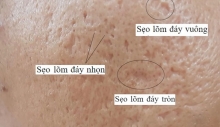 Cách chăm sóc da mặt bị sẹo rỗ: Giải pháp giúp lấy lại làn da mịn màng