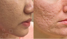 Cách kết hợp nghệ để trị sẹo trên da mặt
