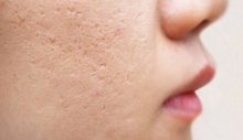 Cách tự nhiên giúp loại bỏ sẹo mụn