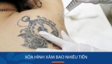 Xoá hình xăm không sẹo bao nhiêu tiền?