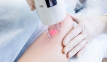Điều trị sẹo do mụn bằng laser!