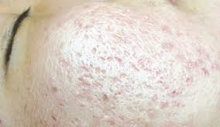 Sẹo sau thủy đậu có tự lành?