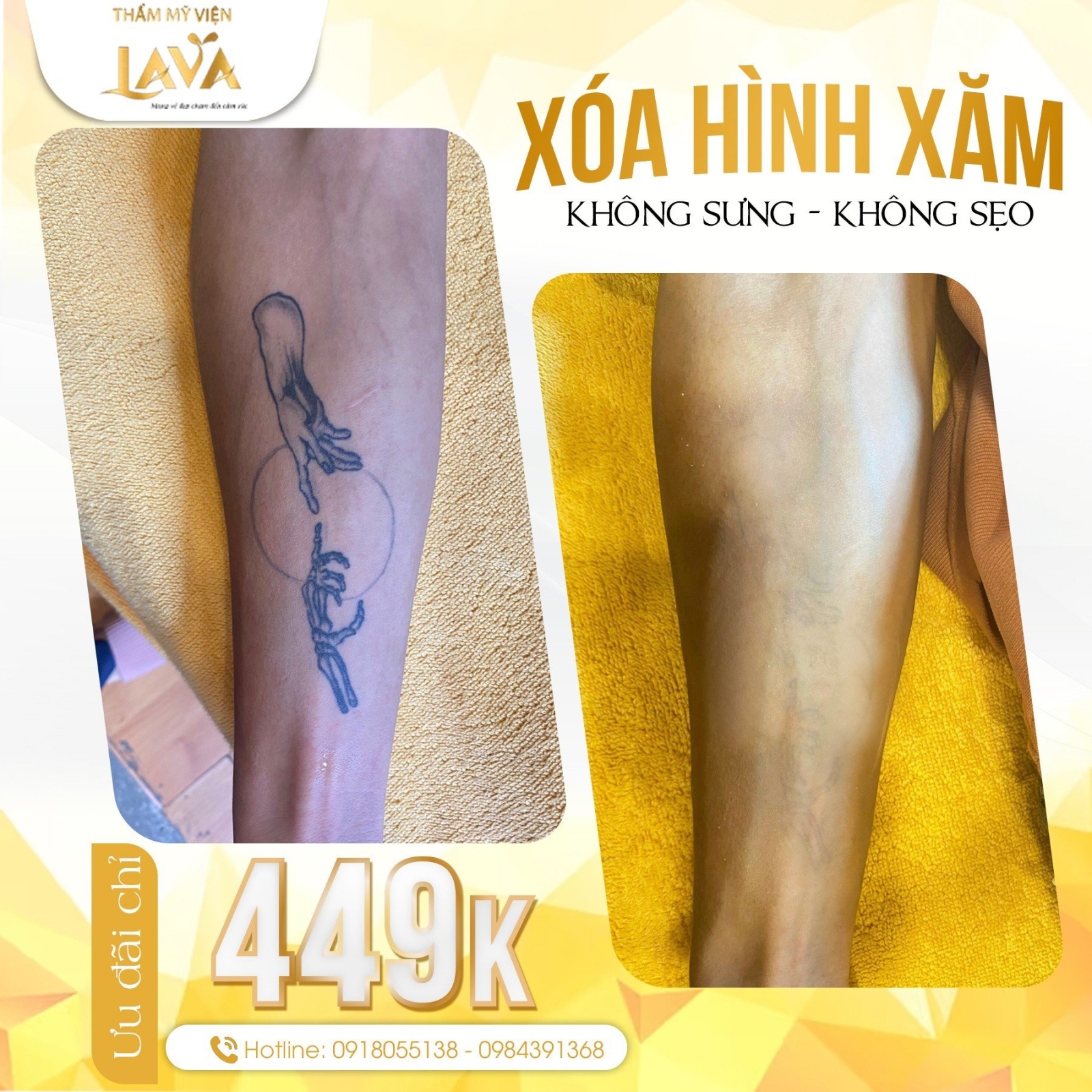 Nỗi khổ xóa hình xăm - VnExpress Sức khỏe