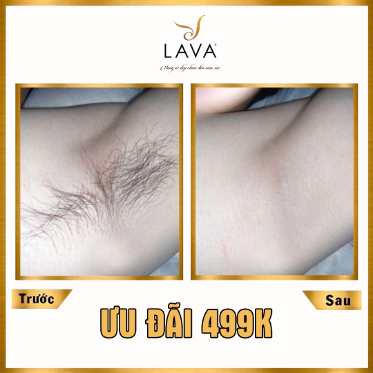 TRIỆT LÔNG 499K